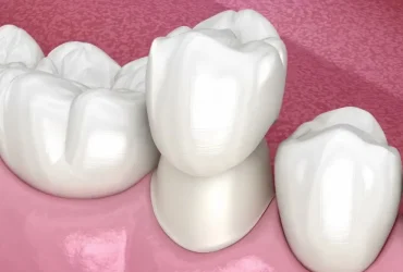 Tooth Restoration