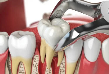 Tooth extraction