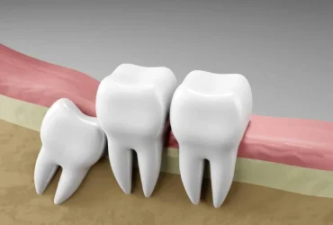 Wisdom teeth removal