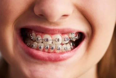 braces