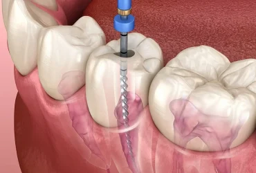 root canal tereatmnet